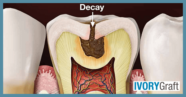 a) Depicting visible fracture lines within the enamel suggestive of