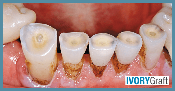 Dentin - Exposure and Loss