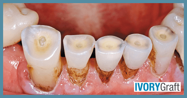 Dentin - Exposure and Tooth Wear - mr