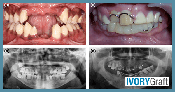 Dentin - Pathologies