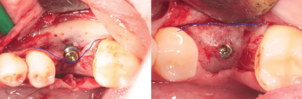 comparison-pre-post-augmentation