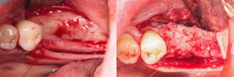 direct-comparison-alveolar