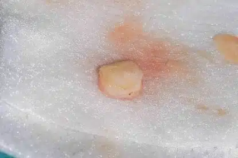 free-gingival-graft