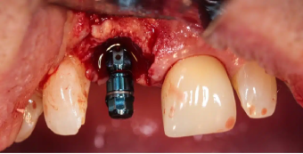implant-placement