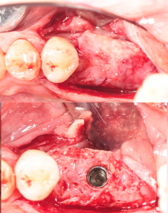 implant-placement