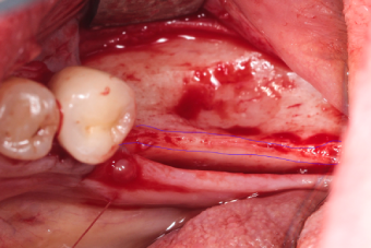 intra-operative