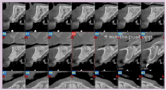 post-op-CBCT-months