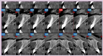 pre-op-CBCT