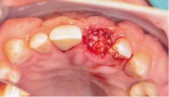 socket-grafting