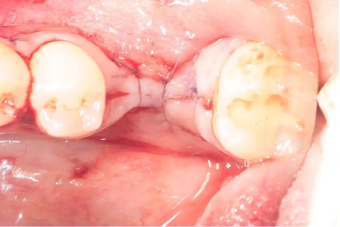 sutured-site
