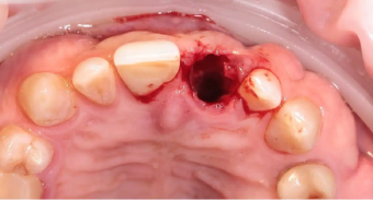 tooth-extraction